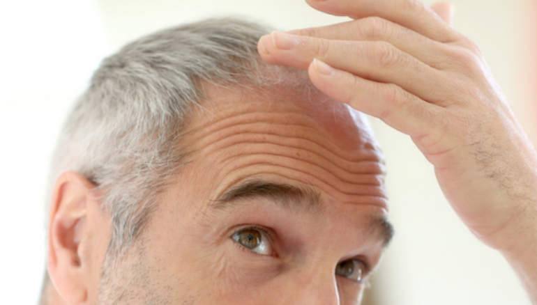 male hair loss